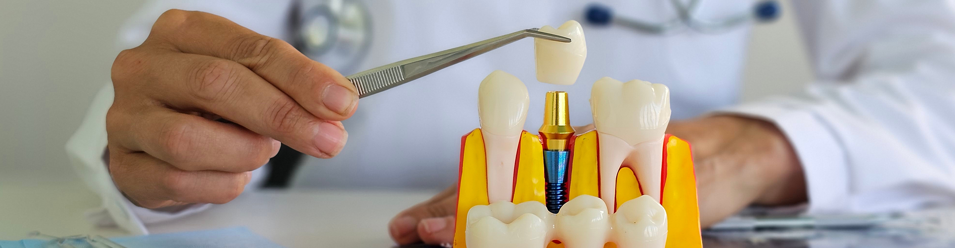 model of dental implants in a jaw.